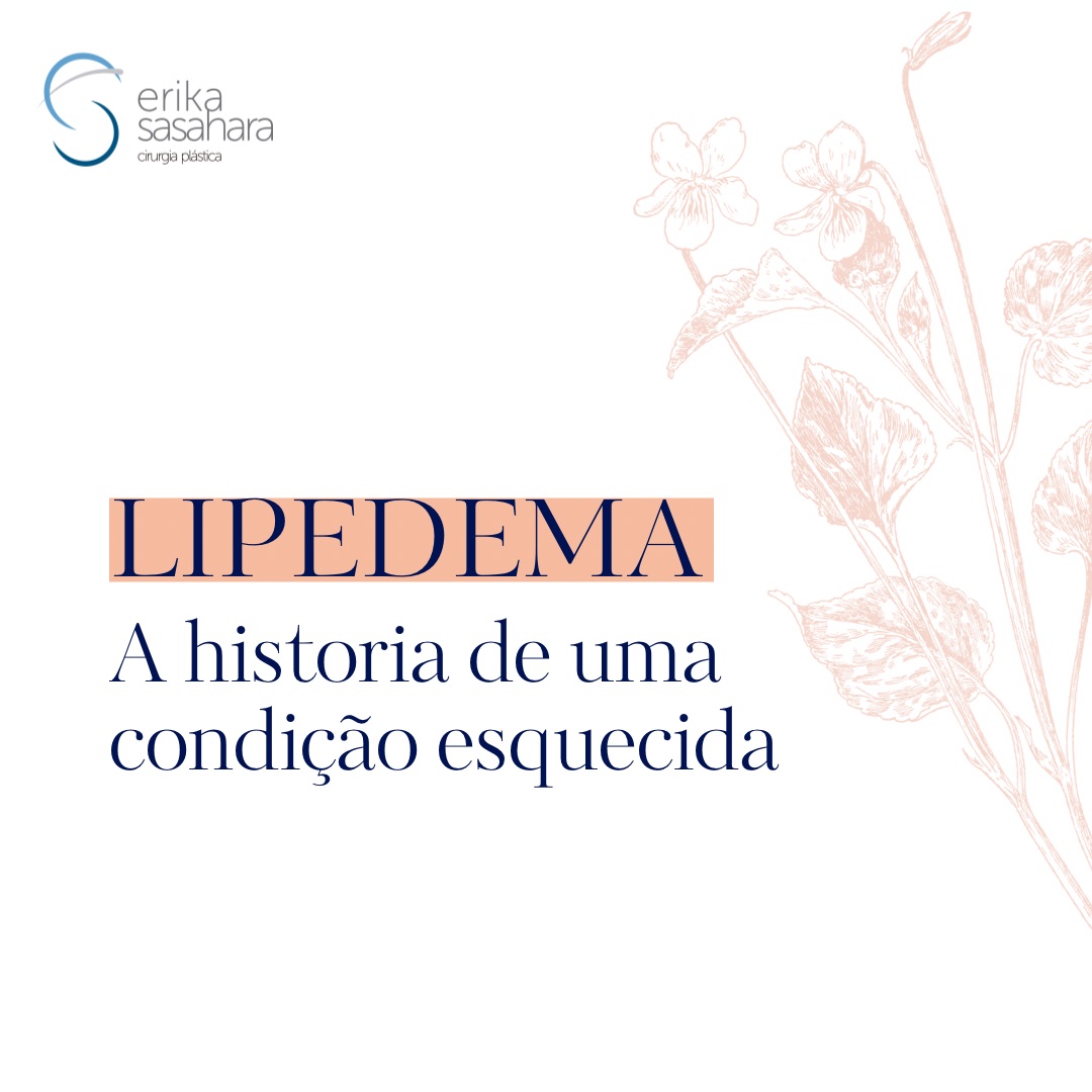 Lipedema - 1